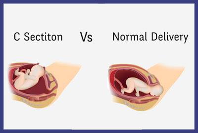 الولادة القيصرية