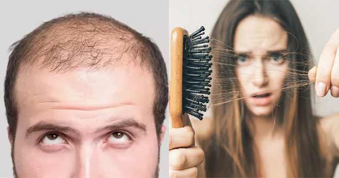 علاج تساقط الشعر الوراثي او الهرموني عند كل من الرجال والسيدات