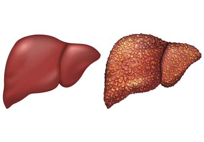 تليف الكبد | أسباب وأعراض وعلاج التليف الكبدي ونصائح عن كيفية الوقاية منه